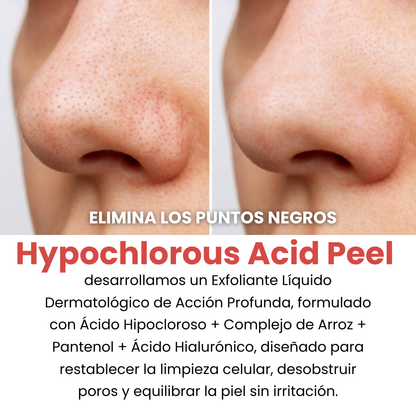 Hypochlorous Acid Peel - Tratamiento para la piel muerta de la cara y poros abiertos